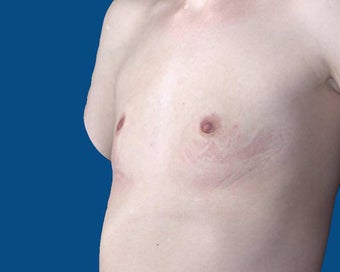 25-34 year old woman treated with Breast Augmentation 3027475