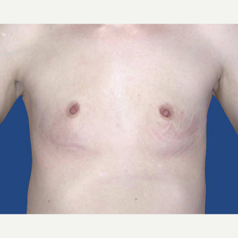 25-34 year old woman treated with Breast Augmentation before 3027475