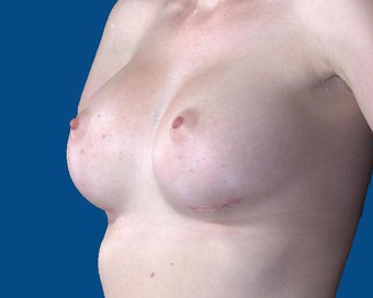 25-34 year old woman treated with Breast Augmentation 3027475