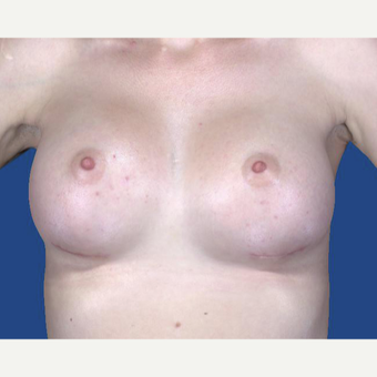 25-34 year old woman treated with Breast Augmentation after 3027475