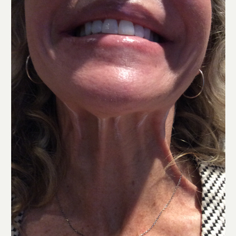 35-44 year old woman treated with Xeomin before 3459386