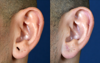 Stretched Earlobe Repair before 524962