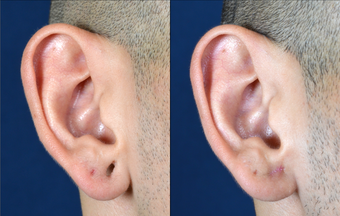 Stretched Earlobe Repair after 524962