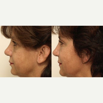 55-64 year old woman treated with Eye Bags Treatment after 2633914