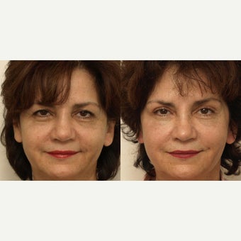 55-64 year old woman treated with Eye Bags Treatment before 2633914