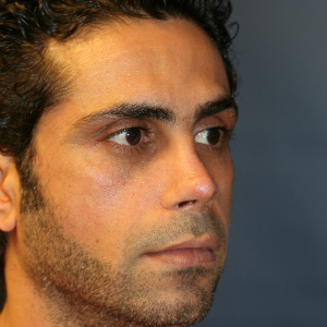 35-44 year old man treated with Revision Rhinoplasty after 3559739