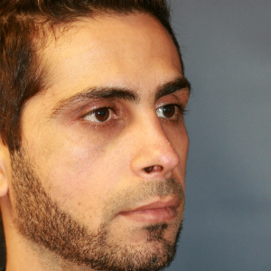 35-44 year old man treated with Revision Rhinoplasty before 3559739