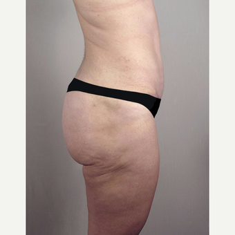 35-44 year old woman treated with Brazilian Butt Lift after 3213479