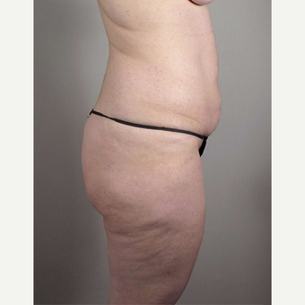 35-44 year old woman treated with Brazilian Butt Lift before 3213479