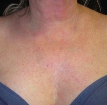 45-54 year old woman treated with Fractional Laser after 1639788
