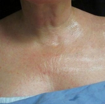 45-54 year old woman treated with Fractional Laser before 1639788