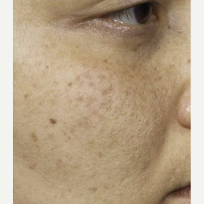 35-44 year old woman treated with Clear + Brilliant Resurfacing after 3098754
