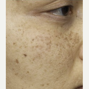35-44 year old woman treated with Clear + Brilliant Resurfacing before 3098754