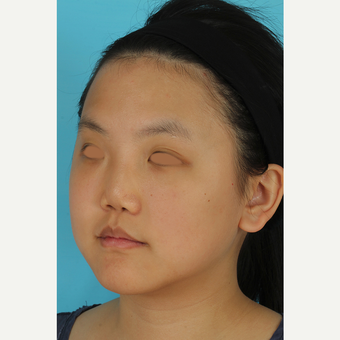 25-34 year old woman treated with Rhinoplasty before 3629024