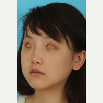 25-34 year old woman treated with Rhinoplasty after 3629024