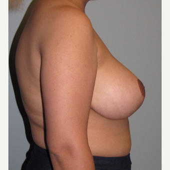 25-34 year old woman treated with Breast Reduction after 3663424