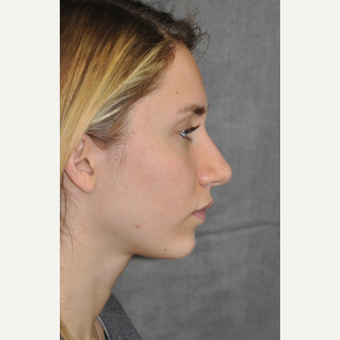 25-34 year old woman treated with Rhinoplasty after 3566051
