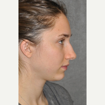 25-34 year old woman treated with Rhinoplasty before 3566051