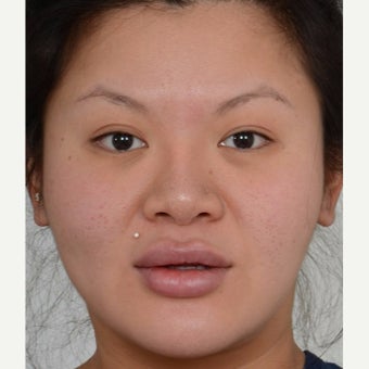 25-34 year old woman treated with Masseter Botox for Jaw Reduction before 2561314