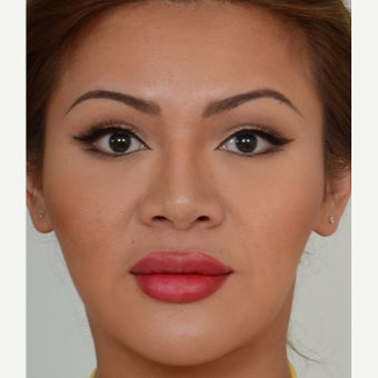 25-34 year old woman treated with Masseter Botox for Jaw Reduction after 2561314