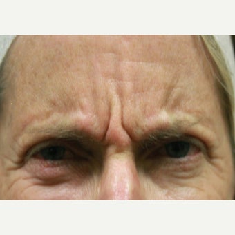 55-64 year old woman treated with Dysport before 1633900