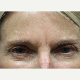 55-64 year old woman treated with Dysport after 1633900