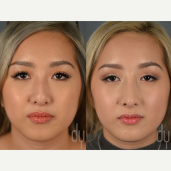 Asian Rhinoplasty with rib cartilage and DCF before 3129826