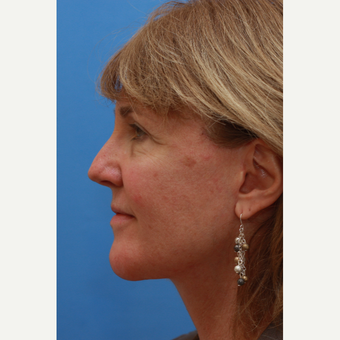 This Lady was treated with a Revisional Neck Lift after 3104744
