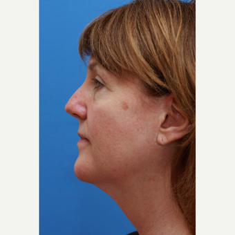 This Lady was treated with a Revisional Neck Lift before 3104744