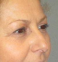 50+ year old woman treated with Natural Appearing Eyelid Surgery and Brow Lift before 2087721