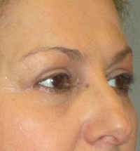 50+ year old woman treated with Natural Appearing Eyelid Surgery and Brow Lift after 2087721