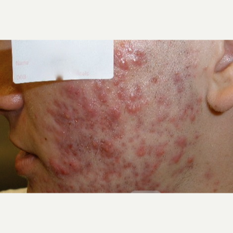 Cystic acne scar treatment before 3685481