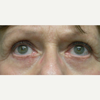 55-64 year old woman treated with Eye Bags Treatment after 3802380