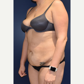 35-44 year old woman treated with Liposuction before 3489810