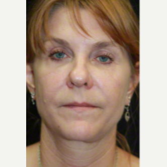 50 year old woman treated with SMAS Facelift after 3629679