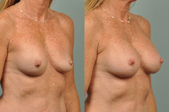 51 year old female implant removal and replace before 1172012
