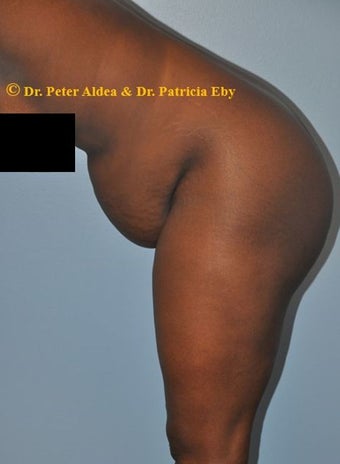 37 year old woman treated with Tummy Tuck and Lifting of the Mons and Anterior Thigh before 2680110