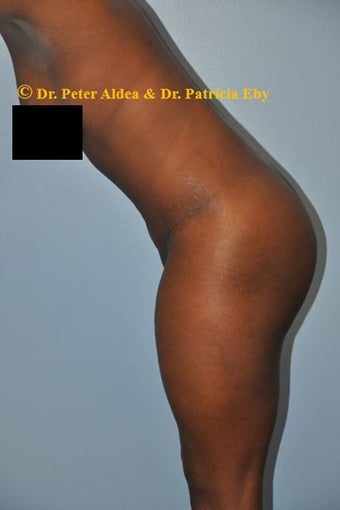 37 year old woman treated with Tummy Tuck and Lifting of the Mons and Anterior Thigh after 2680110