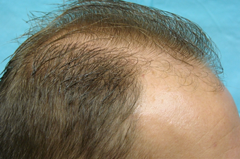 NeoGraft hair transplant before 556379
