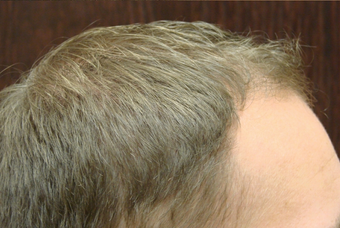 NeoGraft hair transplant after 556379
