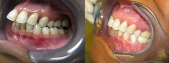 Invisalign (severe overbite) before 1395567