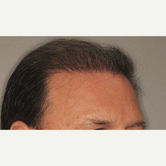 55-64 year old man treated with NeoGraft after 2030242