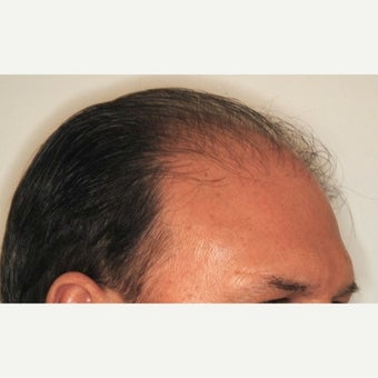 55-64 year old man treated with NeoGraft before 2030242