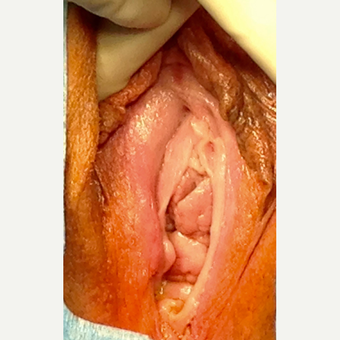 45-54 year old woman treated with Vaginoplasty before 3477642