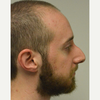 25-34 year old man treated with Nose Surgery before 3099127