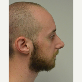 25-34 year old man treated with Nose Surgery after 3099127