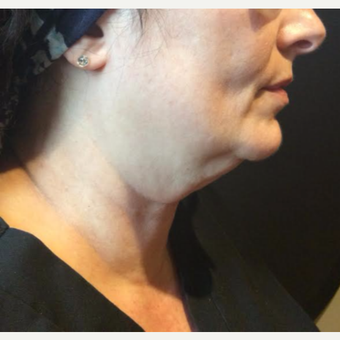 55-64 year old woman treated with Kybella before 3669967