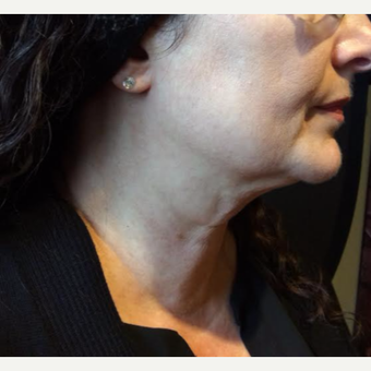 55-64 year old woman treated with Kybella after 3669967