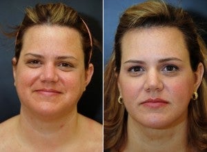 40 year old Neck Lift including Lipocontouring and Suspension 1436635