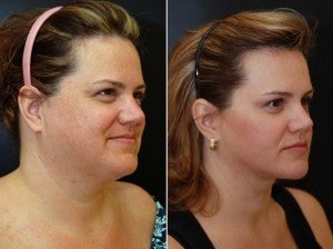 40 year old Neck Lift including Lipocontouring and Suspension after 1436635